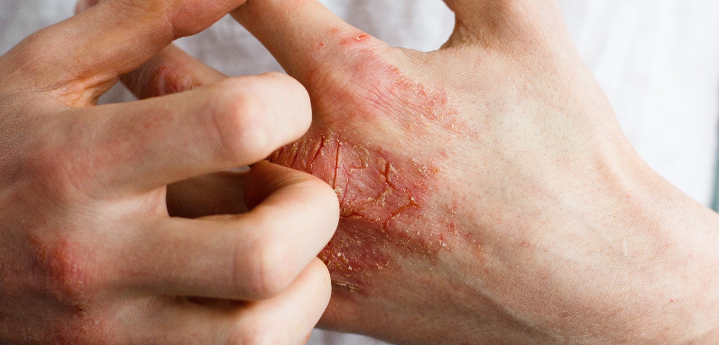 four-tips-managing-winter-eczema